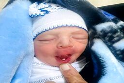 تولد یک نوزاد با دندان + عکس